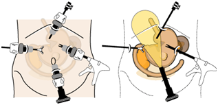 腹腔鏡下胃切除術と腹腔鏡補助下胃切除術のイラスト