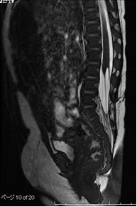 脊髄係留症候群MRI